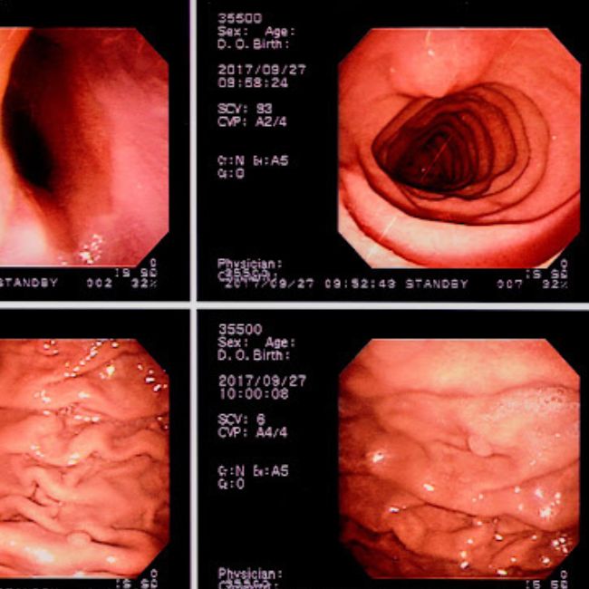STOMACH ULCER