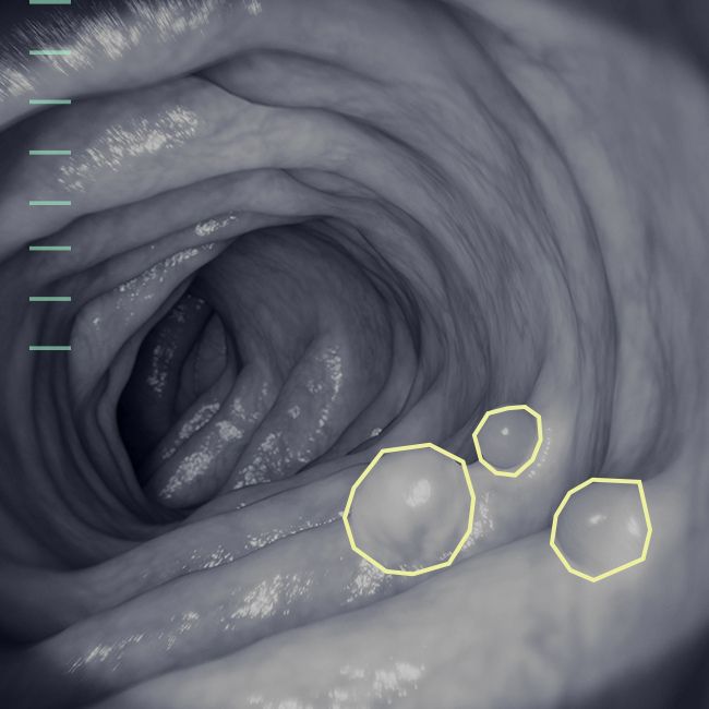bronchoscopy tumors