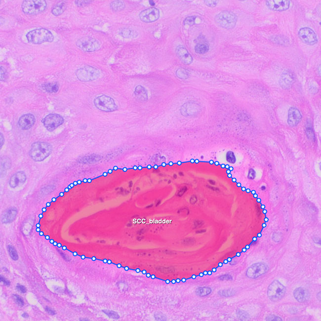 Bladder Cancer