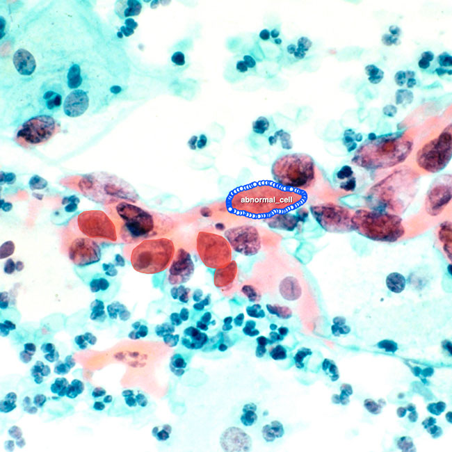 Cervical Cancer