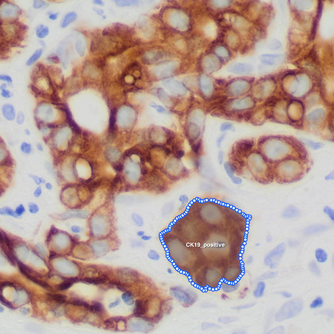 Liver Cancer (HCC)