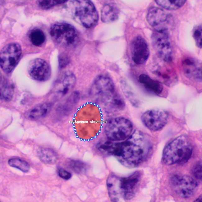 Lung Cancer