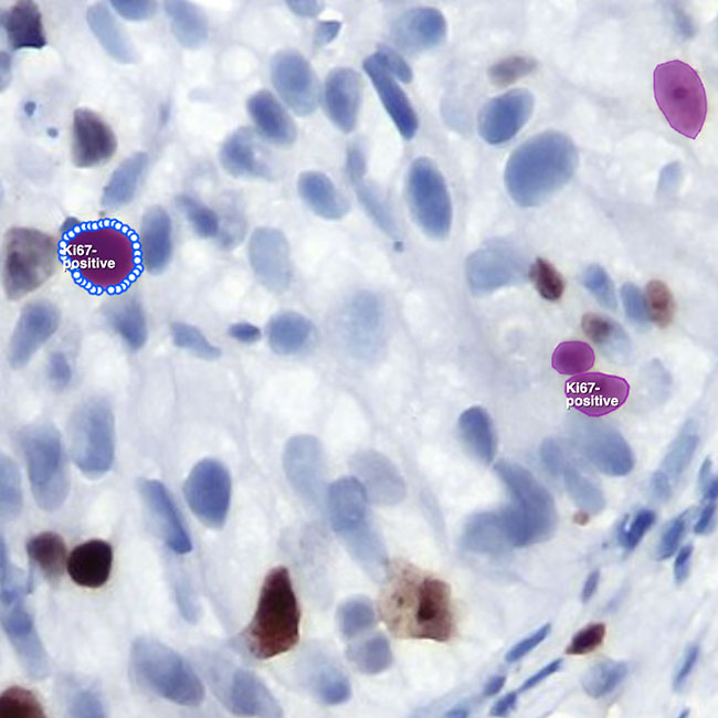 Lymphoma