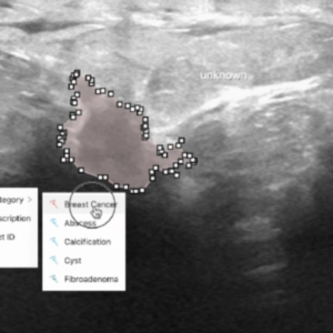 Breast Cancer Diagnosis