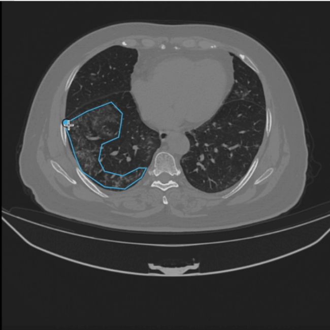 Covid-19 Diagnosis