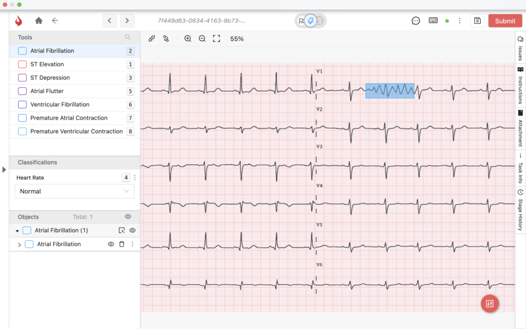 ECG Annotation Visual