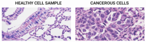 Healthy vs cancerous cells comparison for AI training