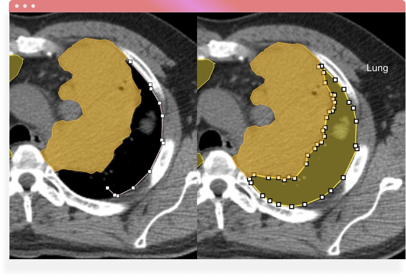 High-precision medical image annotation utilizing semantic segmentation masks to outline anatomical boundaries on a lung CT scan in iMerit Ango Hub.